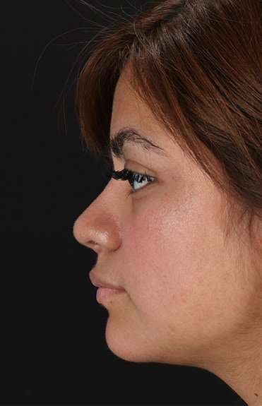 Neck Liposuction Before & After Patient #5709