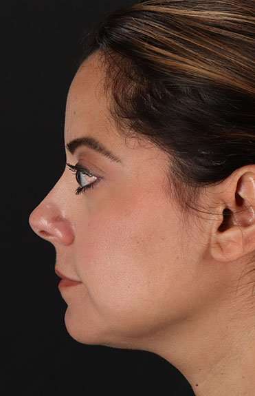 Neck Liposuction Before & After Patient #5720