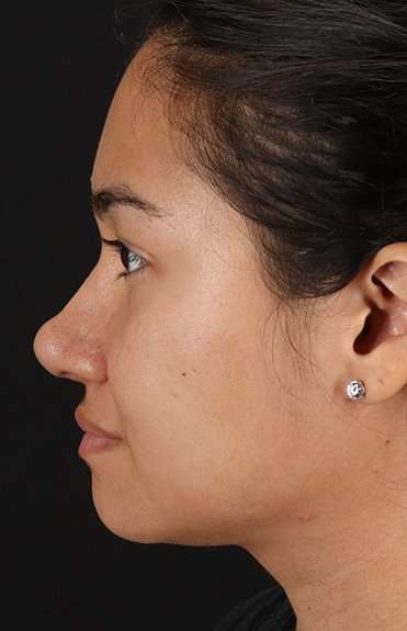 Neck Liposuction Before & After Patient #5742