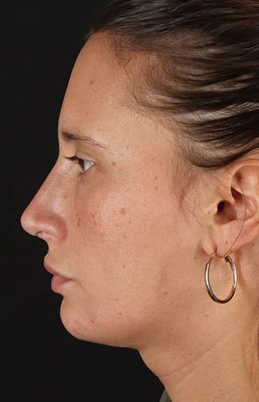 Neck Liposuction Before & After Patient #5753