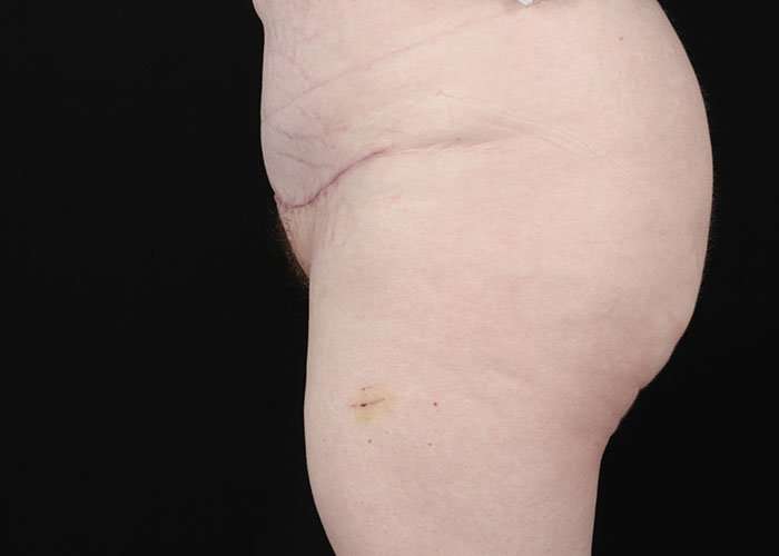 Monsplasty Before & After Patient #1117