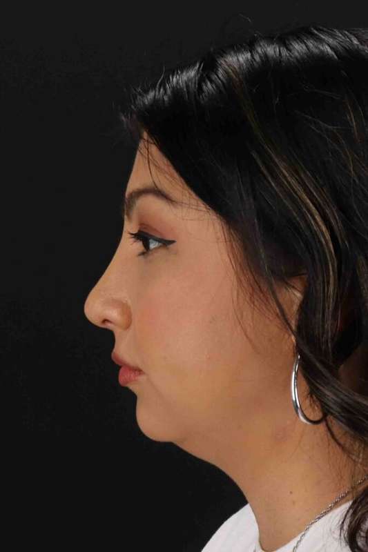 Rhinoplasty Before & After Patient #5826