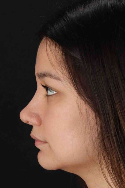 Rhinoplasty Before & After Patient #5837