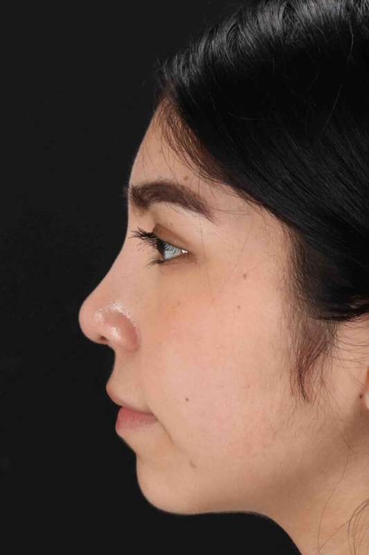Rhinoplasty Before & After Patient #5848
