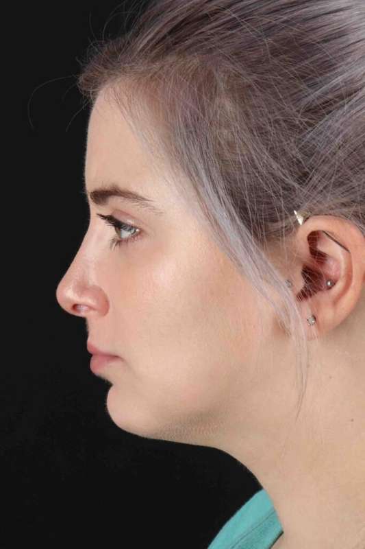 Rhinoplasty Before & After Patient #5859