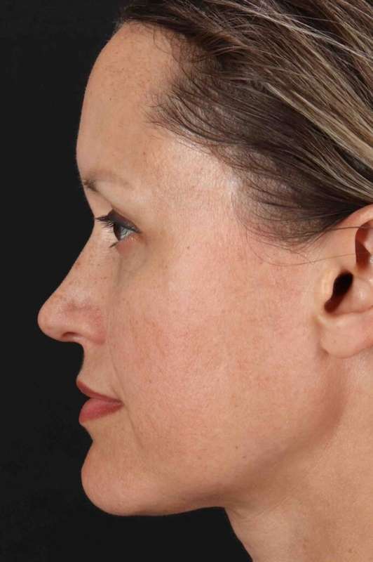 Rhinoplasty Before & After Patient #5870