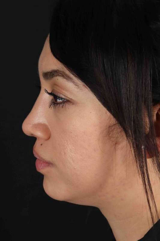 Rhinoplasty Before & After Patient #5881