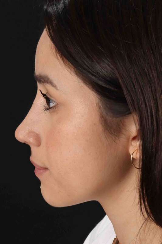 Rhinoplasty Before & After Patient #5892