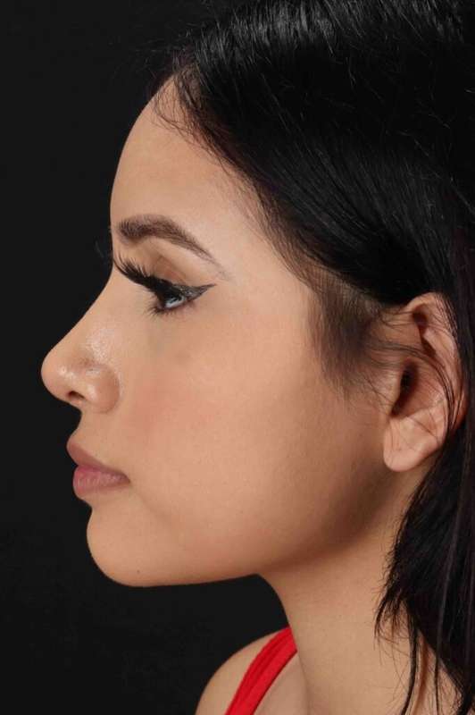 Rhinoplasty Before & After Patient #5903