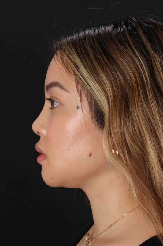 Rhinoplasty Before & After Patient #5914