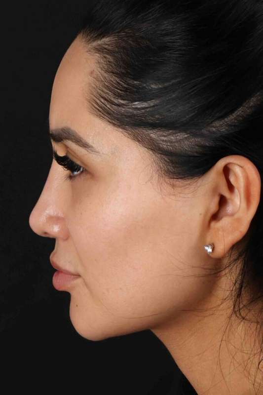 Rhinoplasty Before & After Patient #5925