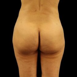 Cosmetic Body Lift Before & After Patient #1186