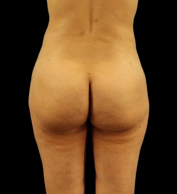 Cosmetic Body Lift Before & After Patient #1186