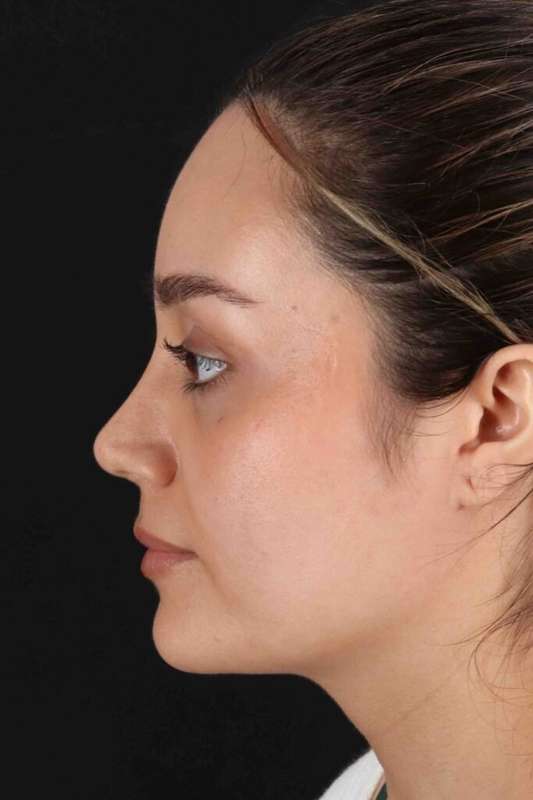 Rhinoplasty Before & After Patient #5947