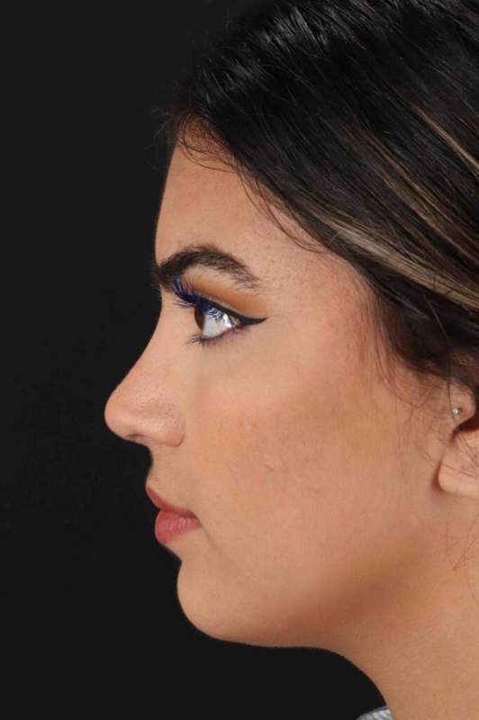 Rhinoplasty Before & After Patient #5958