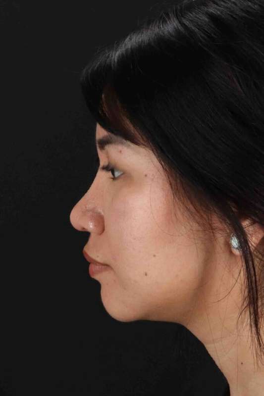 Rhinoplasty Before & After Patient #5983