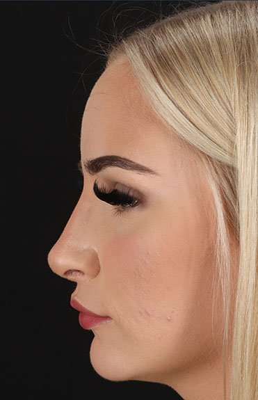 Rhinoplasty Before & After Patient #6005