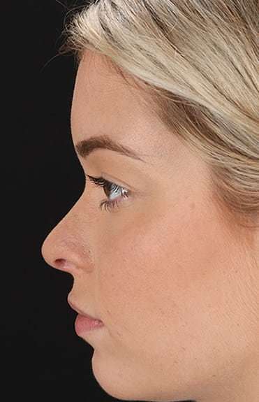 Rhinoplasty Before & After Patient #6178