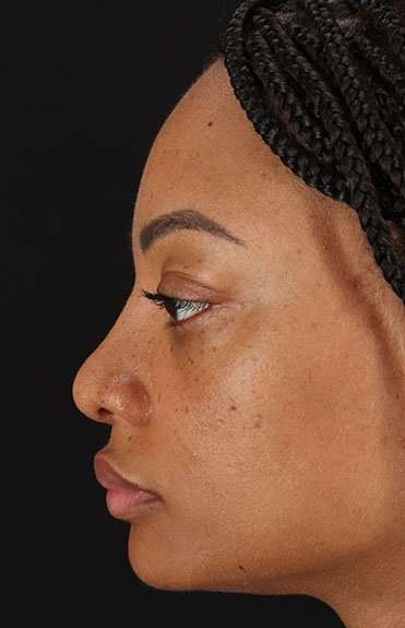 Rhinoplasty Before & After Patient #6189