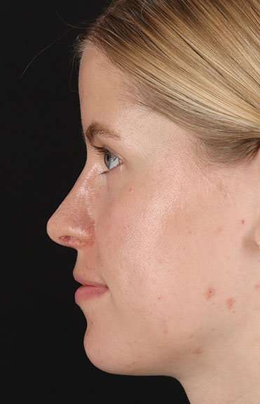 Rhinoplasty Before & After Patient #6200