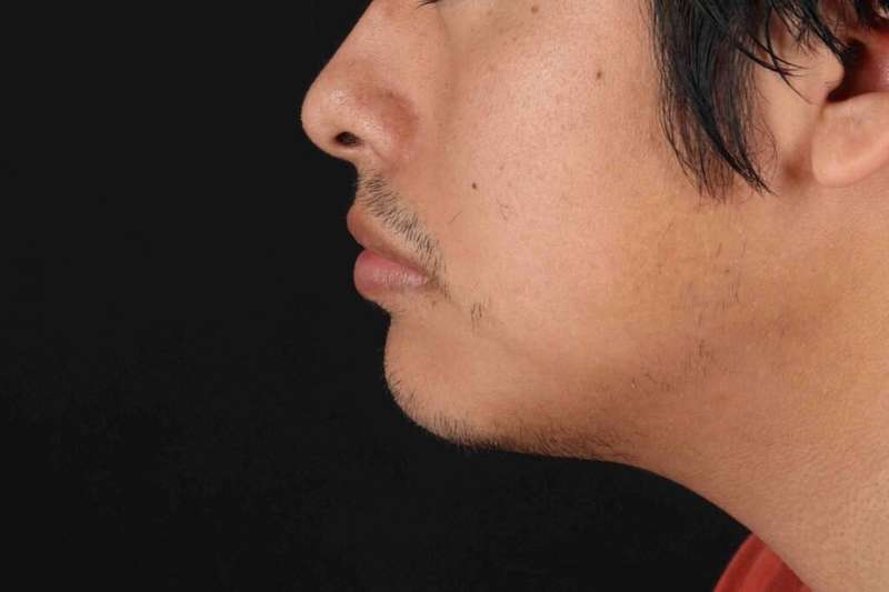Lip Reduction Before & After Patient #6233