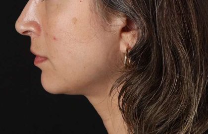 Lip Lift Before & After Patient #6244