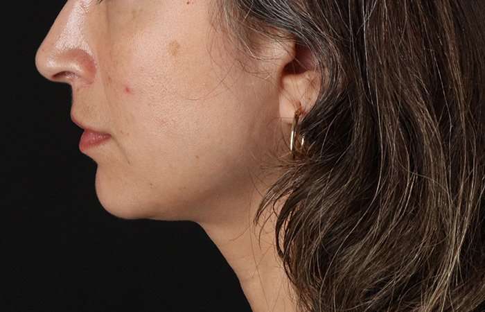Lip Lift Before & After Patient #6244