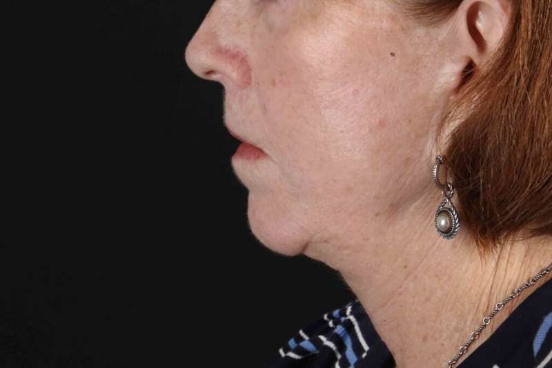 Lip Lift Before & After Patient #6255