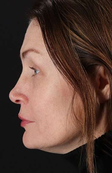 Lip Lift Before & After Patient #6266