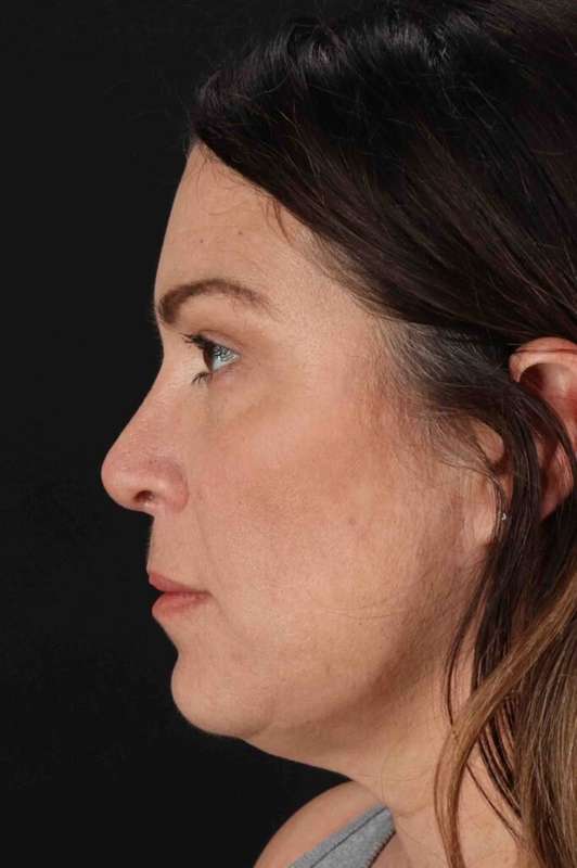 Lip Lift Before & After Patient #6277