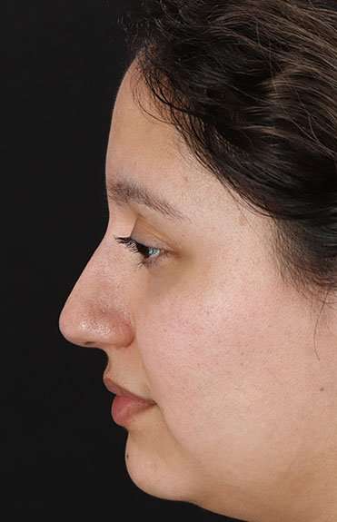 Liquid Rhinoplasty Before & After Patient #6299