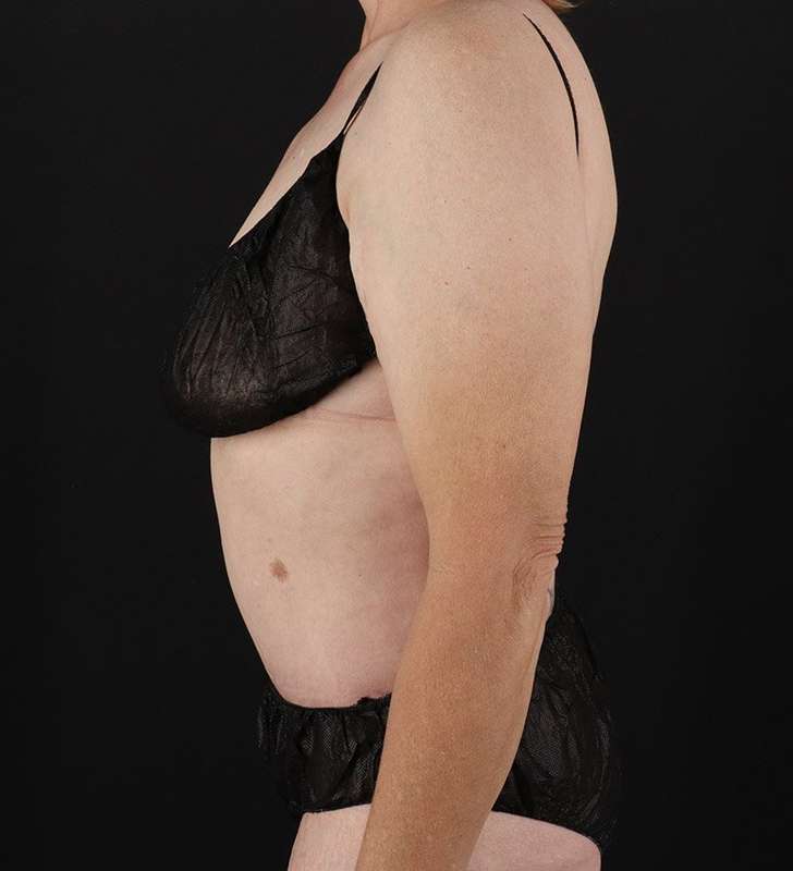 Cosmetic Body Lift Before & After Patient #1218