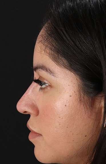 Liquid Rhinoplasty Before & After Patient #6319