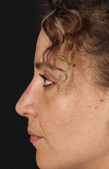 Liquid Rhinoplasty Before & After Patient #6333