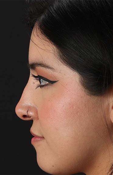 Liquid Rhinoplasty Before & After Patient #6344
