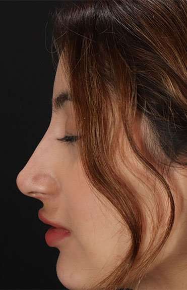 Liquid Rhinoplasty Before & After Patient #6355