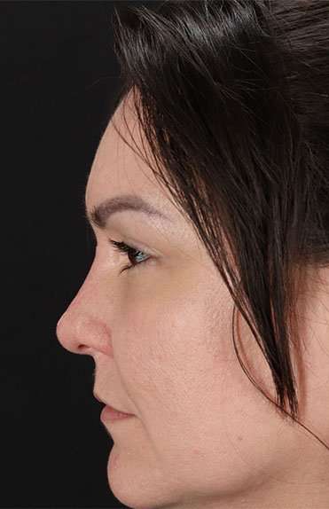 Liquid Rhinoplasty Before & After Patient #6366