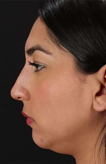Liquid Rhinoplasty Before & After Patient #6377