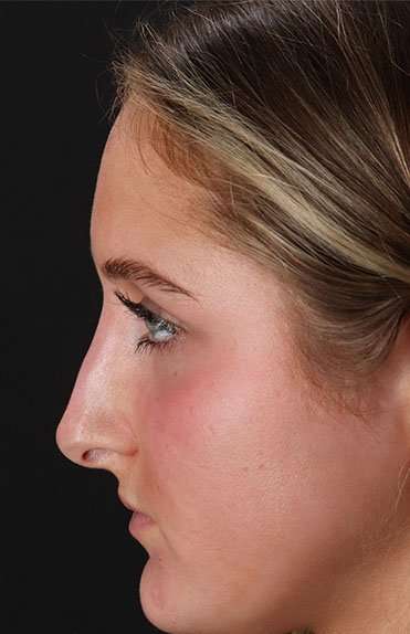 Liquid Rhinoplasty Before & After Patient #6388