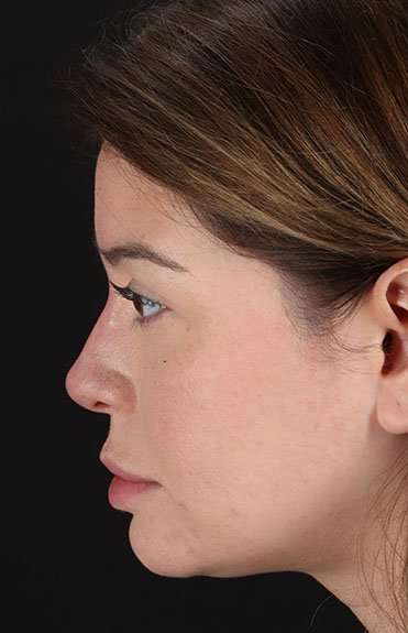Liquid Rhinoplasty Before & After Patient #6399