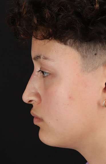 Liquid Rhinoplasty Before & After Patient #6410