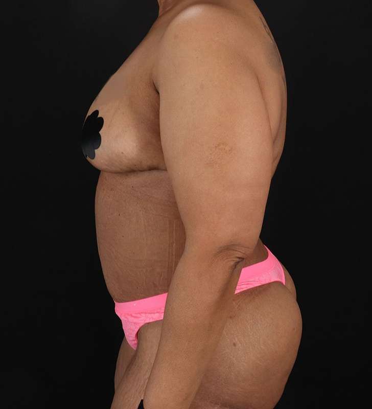 Cosmetic Body Lift Before & After Patient #1234