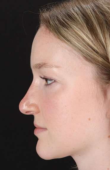 Liquid Rhinoplasty Before & After Patient #6425