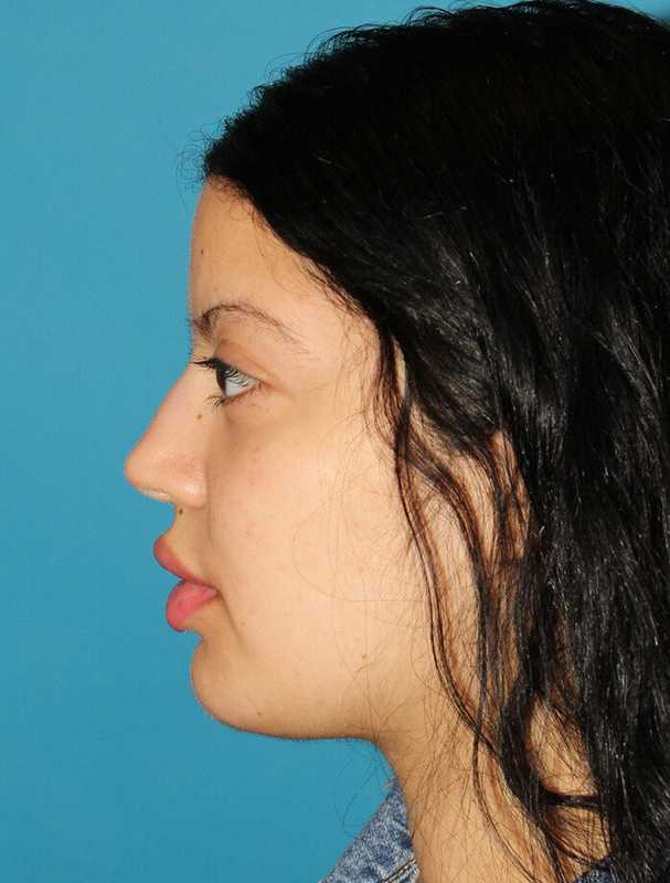 Buccal Fat Pad Before & After Patient #6436