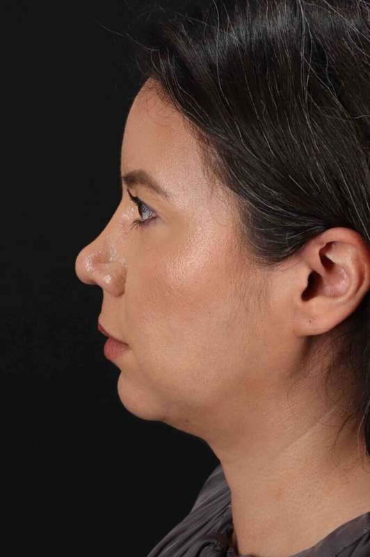 Buccal Fat Pad Before & After Patient #6463