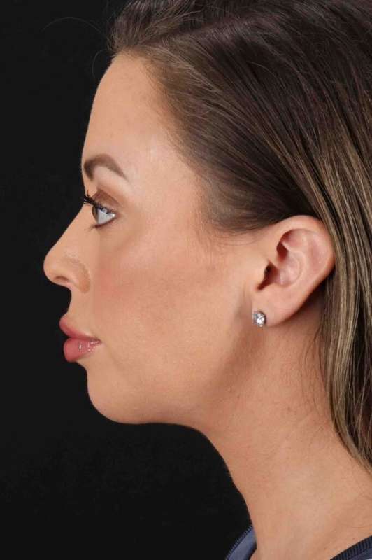 Buccal Fat Pad Before & After Patient #6474