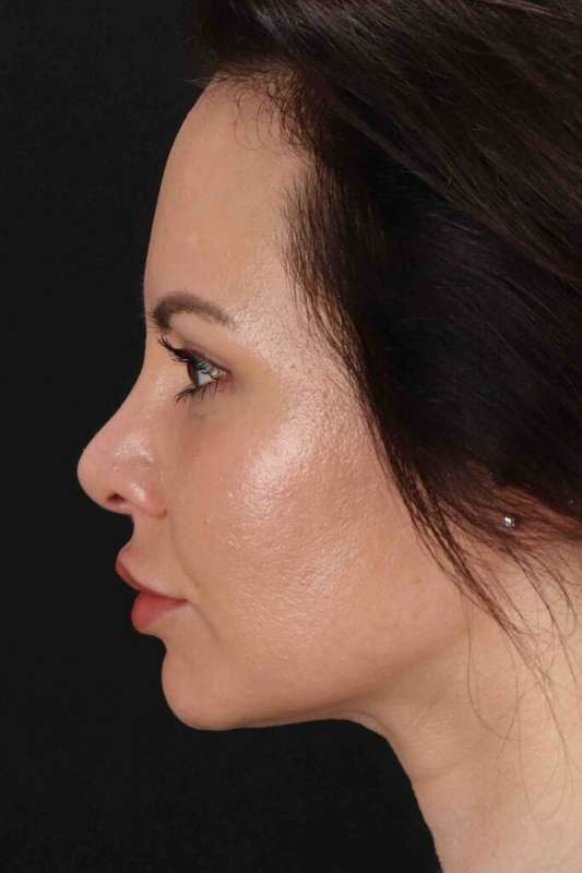 Buccal Fat Pad Before & After Patient #6496