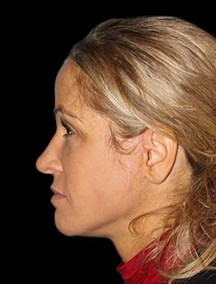 Neck Lift Before & After Patient #6517