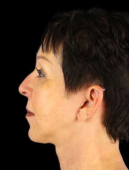 Neck Lift Before & After Patient #6528