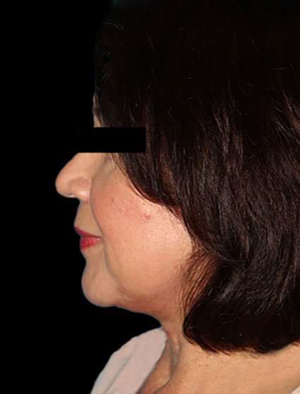 Neck Lift Before & After Patient #6539